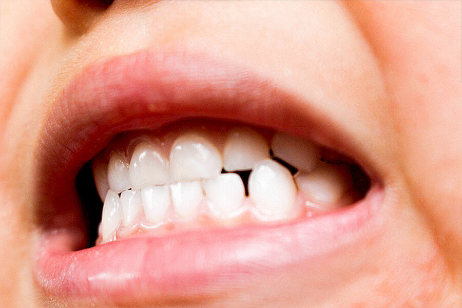 歯ぎしりの主な種類