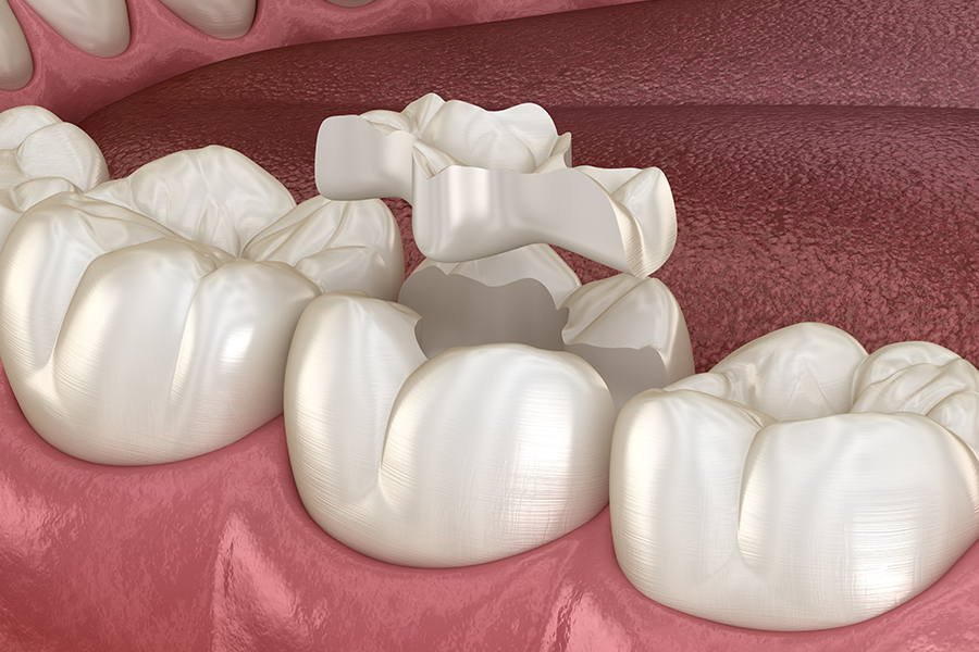 セラミックインレー（e-max）