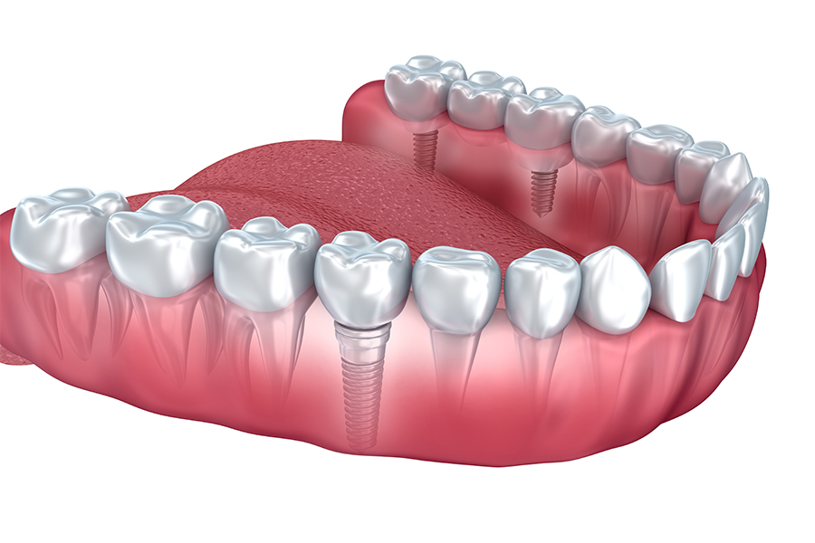 インプラント治療のメリット・デメリット