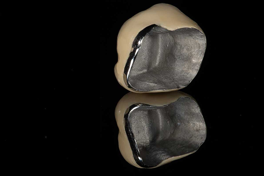 ハイブリットクラウン（セラミックとプラスチックの混合物の下に金属のフレーム）