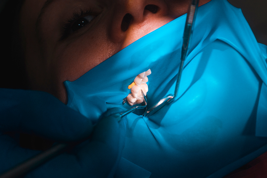 ラバーダムを用いた根管治療について