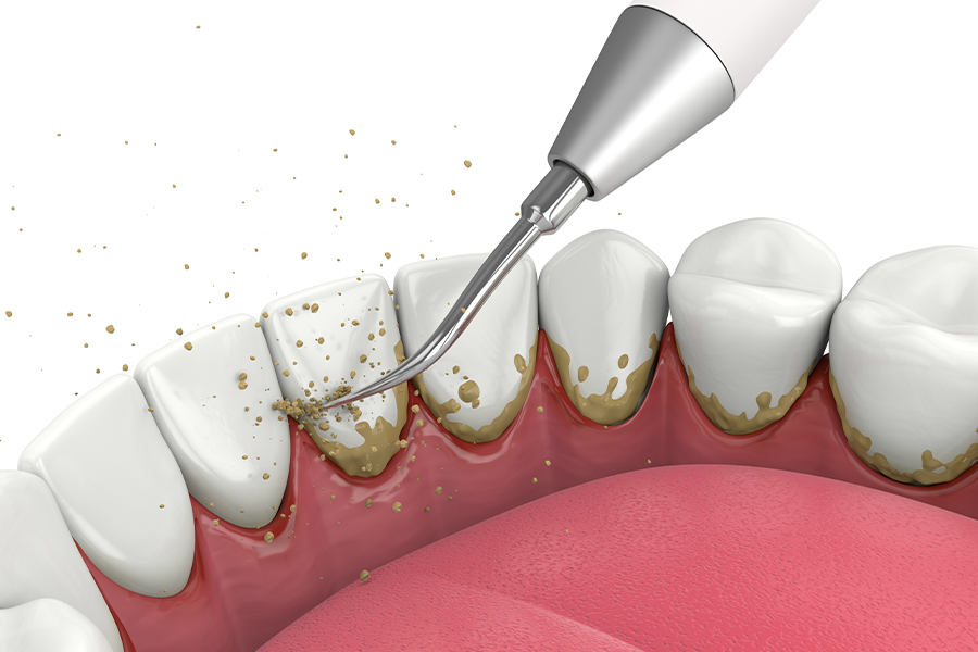 歯石やバイオフィルムについて