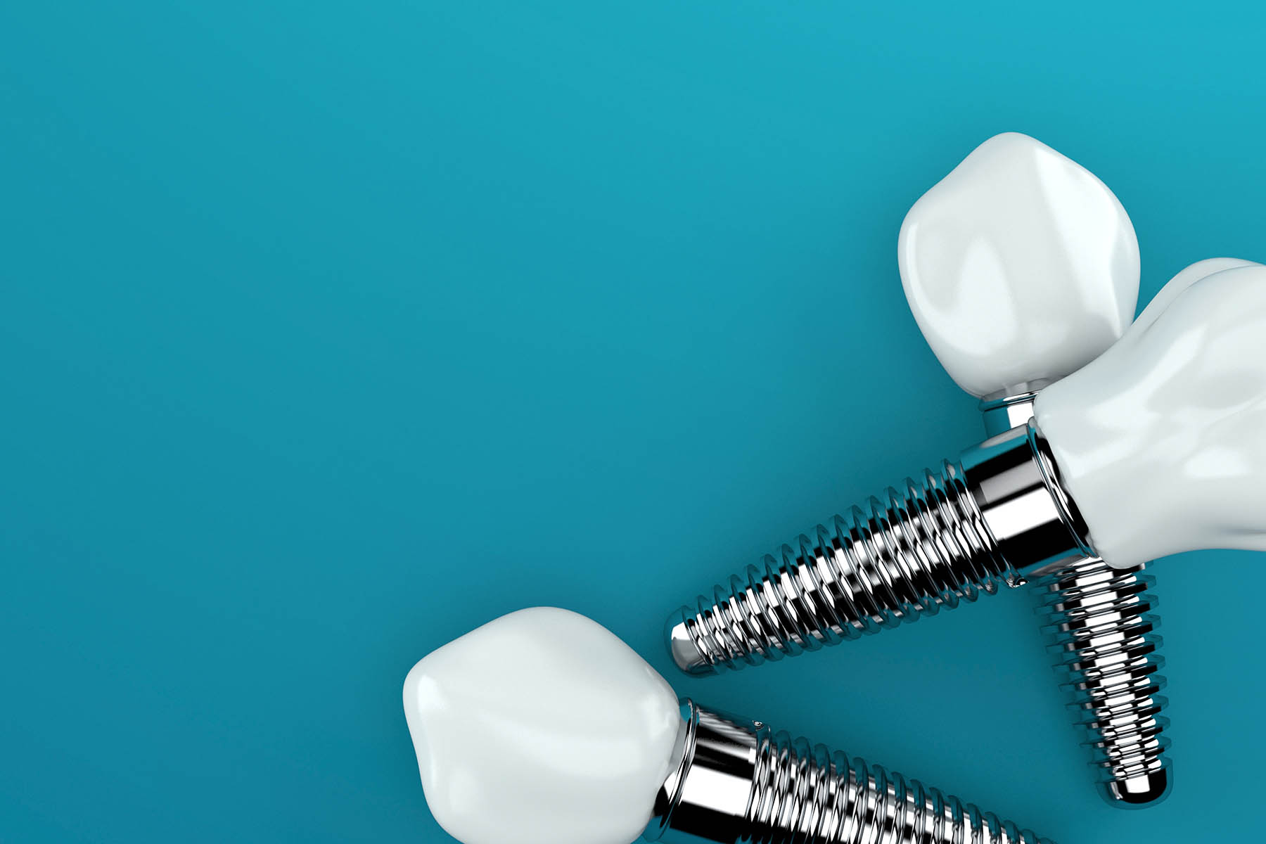 インプラント寿命について