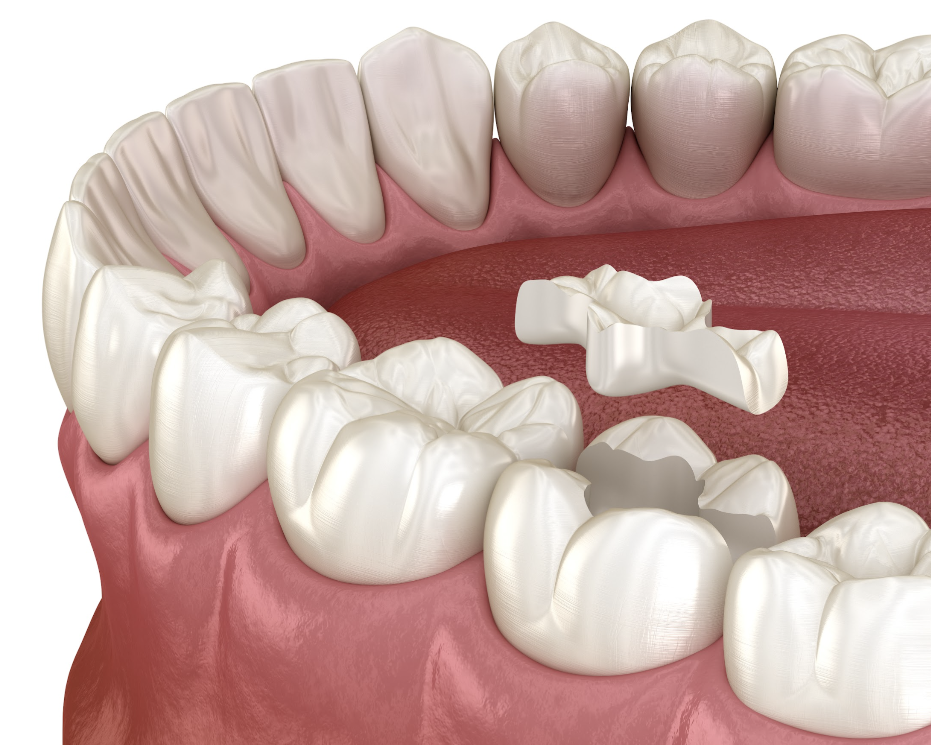 ハイブリットインレー（セラミックとプラスチックの混合物）